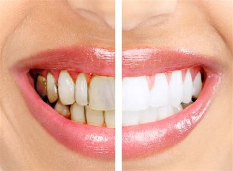 What is Gingivitis? | Stonehill Dental: Hamilton Dentist