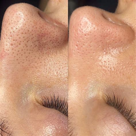 HydraFacial Sono Bella Clinic