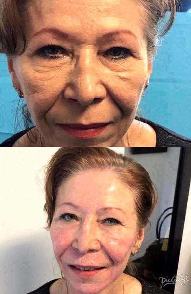 The Vampire Facelift Before And After (2) » Facelift: Info, Prices ...