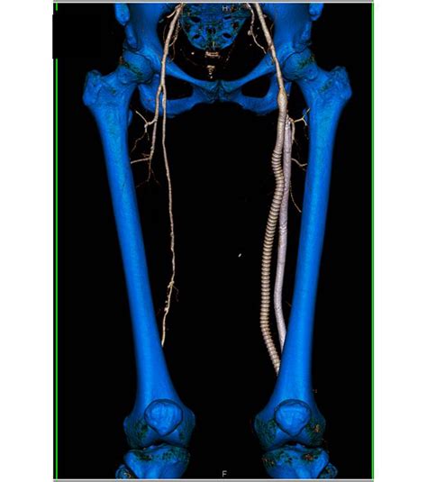 Femoral Artery Bypass Graft