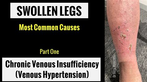 Swollen Legs Uncovering The Causes Focus On Chronic Venous