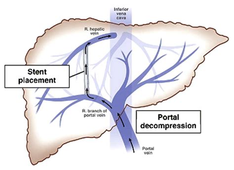 Transjugular Intrahepatic Portosystemic Shunt Diagram