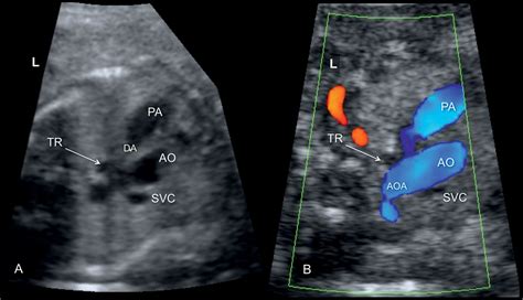 Right Aortic Arch Double Aortic Arch And Aberrant Subclavian Artery Obgyn Key