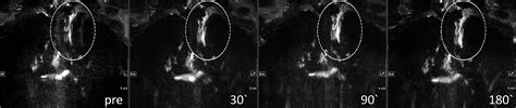 T2 Weighted High Resolution Isotropic Magnetic Resonance