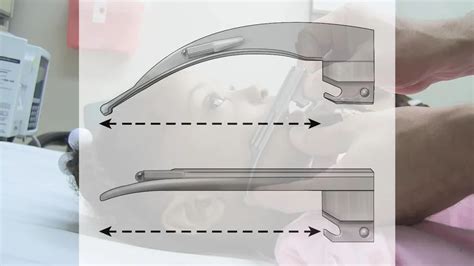 Direct Straight Pediatric Laryngoscope SET Size Of Blade 2 At Rs 1250