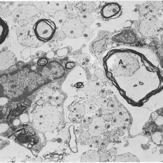 BALB C Mouse Spinal Cord 14 DPI Naked Axons Macrophages And Myelin