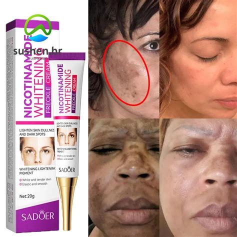 SUSBR Creme Sardas Remover Melasma Nicotinamida Clareador Manchas