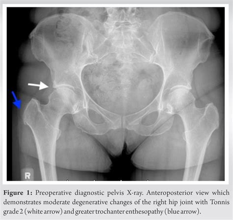 Endoscopic Repair Of Hip Abductor Tendon Tears A Case Report Journal Of Orthopaedic Case Reports