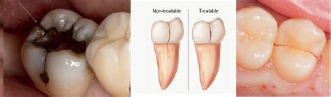 Cracked Tooth Sydrome