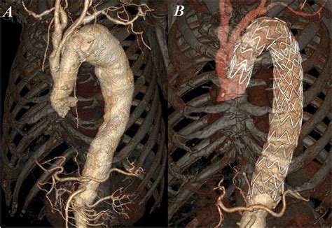 A Preoperative Three Dimensional Computed Tomography Ct