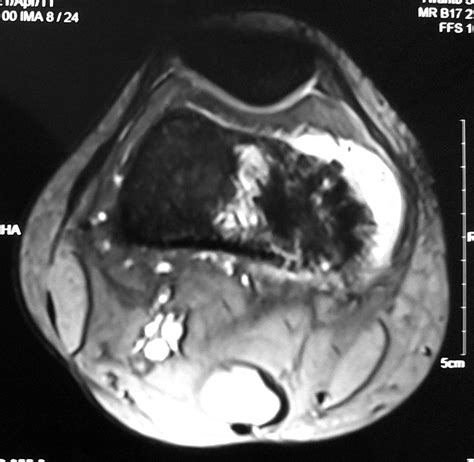 Radiodiagnosis Imaging Is Amazing Interesting Cases Osteosarcoma Of