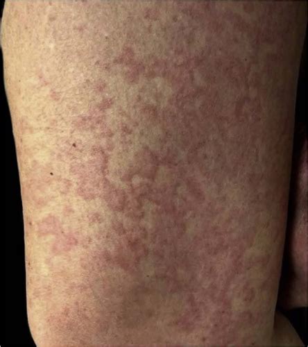 Scielo Brasil Cutaneous Manifestations Of Covid Patients In A