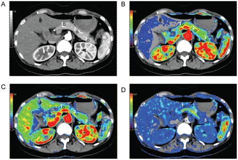 A Transverse Ct Image B D Ct Perfusion Parametric Maps For Blood