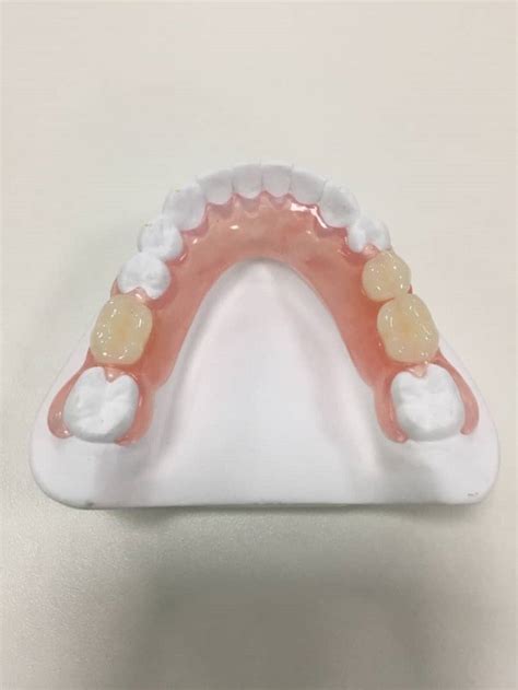 Flexible Denture One Of Our Useful Services