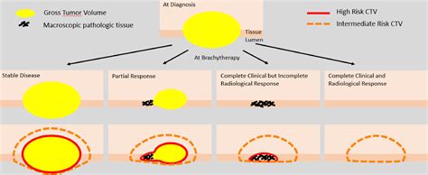 Gec Estro Acrop Abscbg Consensus Brachytherapy Target Definition