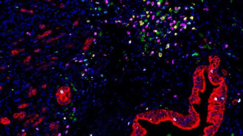 Link Between Immune Cells’ Neighbors And Pancreatic Cancer Survival Technology Networks