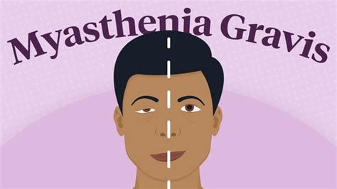 Myasthenia Gravis Symptoms Causes And Treatment