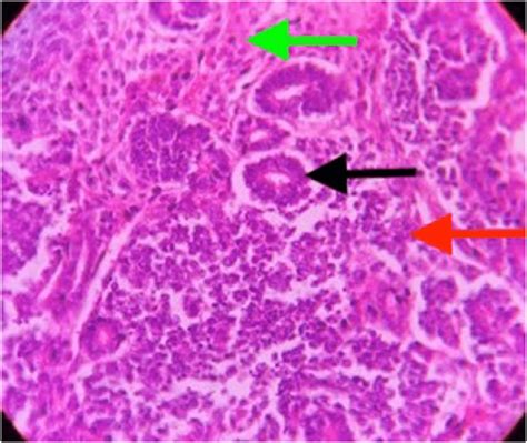 Photomicrograph 100x Hande Showing Histological Features Of A