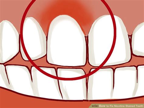 3 Ways To Fix Nicotine Stained Teeth Wikihow