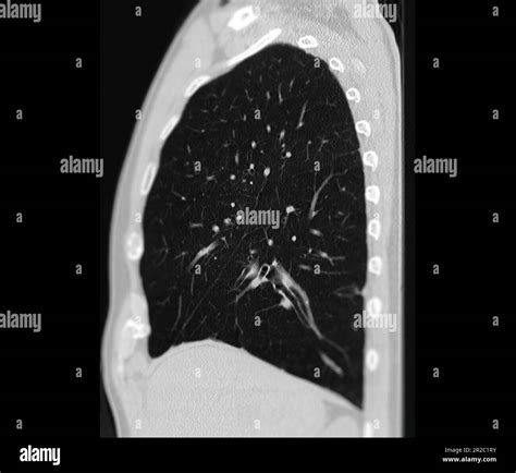 CT scan of Chest or lung for screening lung nodules and lung cancer ...