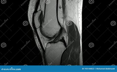 Magnetic Resonance Images Of The Knee Joint Sagittal T1 Weighted