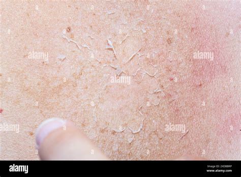 Macro Of Dry Skin Finger Peeling Off Shreds Of Dehydrated Skin From