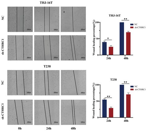 CTHRC1 Promotes Anaplastic Thyroid Cancer Progression By Upregulating