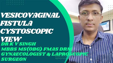 Vesicovaginal Fistula Cystoscopic View YouTube