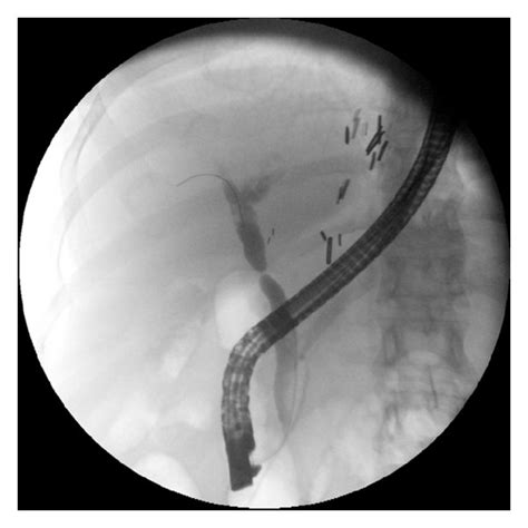 Cholangiogram Of A Patient With Postliver Transplant Anastomotic