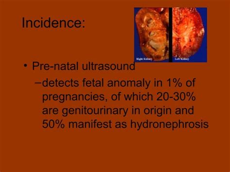 Neonatal Hydronephrosis Ppt