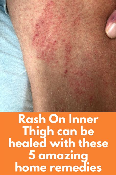 Fungal Rash On Inner Thigh