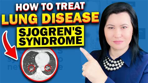 How To Treat Lung Disease In Sjogren S Syndrome Youtube