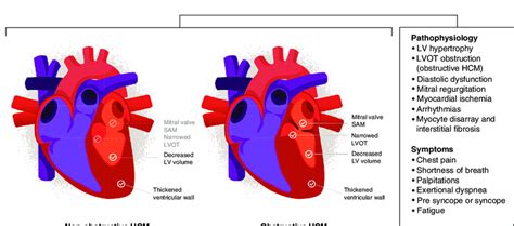 Hypertrophic Cardiomyopathy Pathophysiology And Common Symptoms Hcm