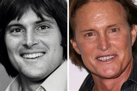 Bruce Jenner Plastische Chirurgie Vorher Nachher Fotos Plastische