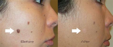 Cherry Angioma Removal Laser : Cherry Angioma Removal Hemangioma ...