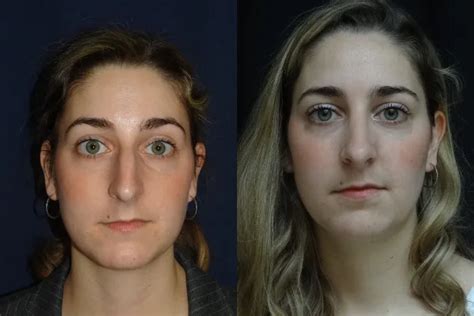 Rhinoplasty For Nasal Bridge Correction Associates In Plastic Surgery