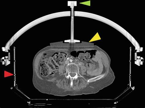 Stereotactic Radiotherapy for Lung Tumors | Radiology Key