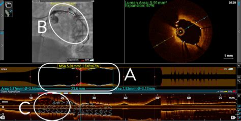 Intravascular Imaging Optical Coherence Tomography Oct Lightlab Outcomes Abbott