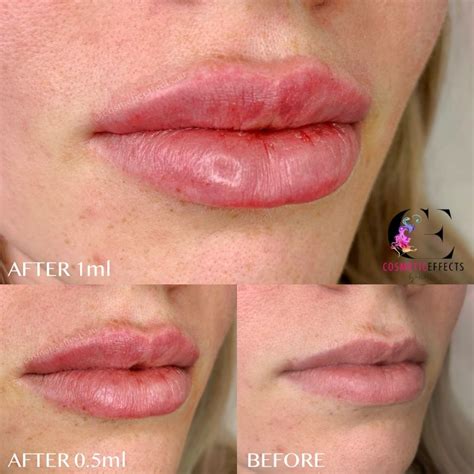 0 5ml Or 1ml Of Lip Fillers What S Right For You Lip Fillers Lips