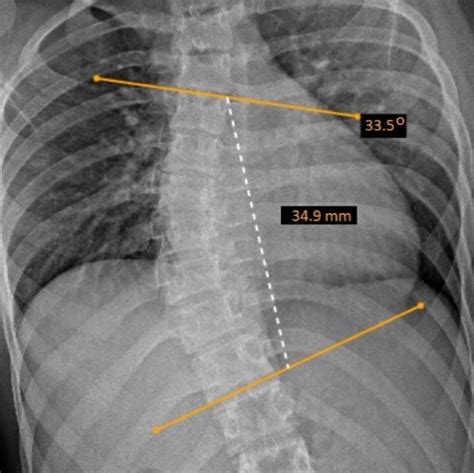 Cobb Angle – AlemHealth