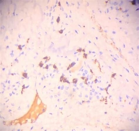 An Unusual Presentation Of Chronic Sclerosing Sialadenitis Of