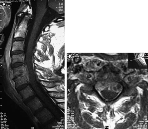 Cervical Spinal Brucellosis Causing Epidural And Prevertebral Abscesses