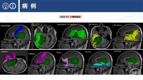 上海长海医院神经外科：丘脑巨大胶质瘤诊断及手术的精准理念 脑医汇 神外资讯 神介资讯