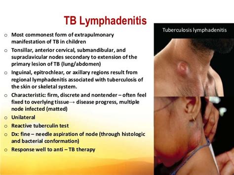 Clinical Approach Fever Lymphadenopathy