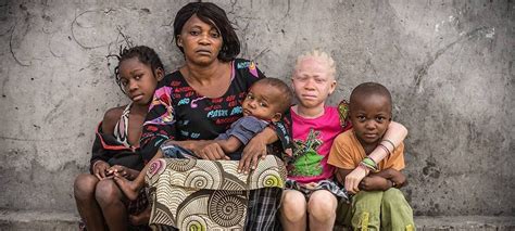 Albino People Hunted In Africa