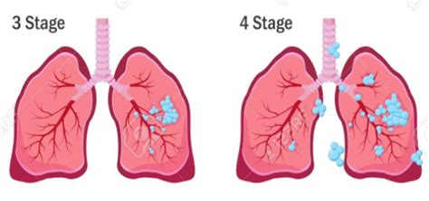 Recurrence, Progression and Metastatic Lung Cancer