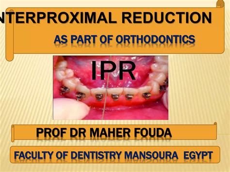 Interproximal Reduction Of Enamel As Part Of Orthodontics Ppt