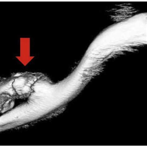 Three Dimensional Computed Tomography Reconstruction Demonstrating Download Scientific Diagram