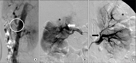 Aortogram And Selective Bilateral Renal Arteriograms Confirmed Multiple Download Scientific