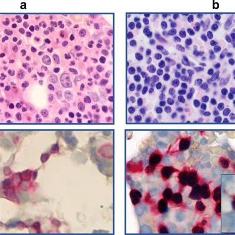 A Bone Marrow Core Biopsy No Definitive Morphologic Evidence Of Cll By